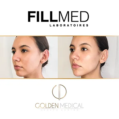 3er lugar internacional Jawline de Fillmed